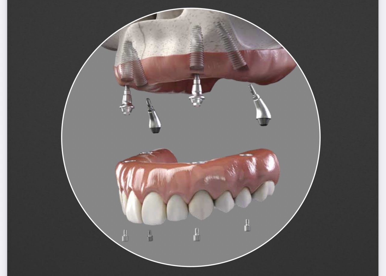 medicare dental implants